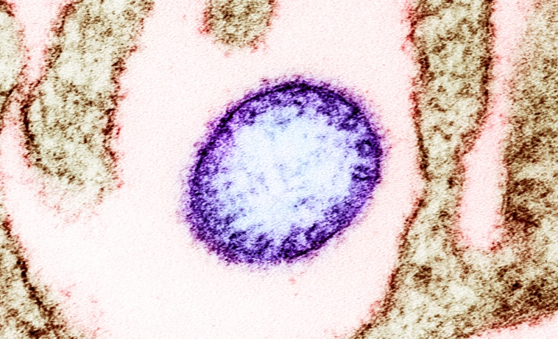 Partly_True: Nipah virus infection has the same symptoms as COVID-19.